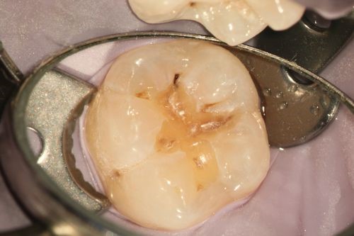 治療前の虫歯