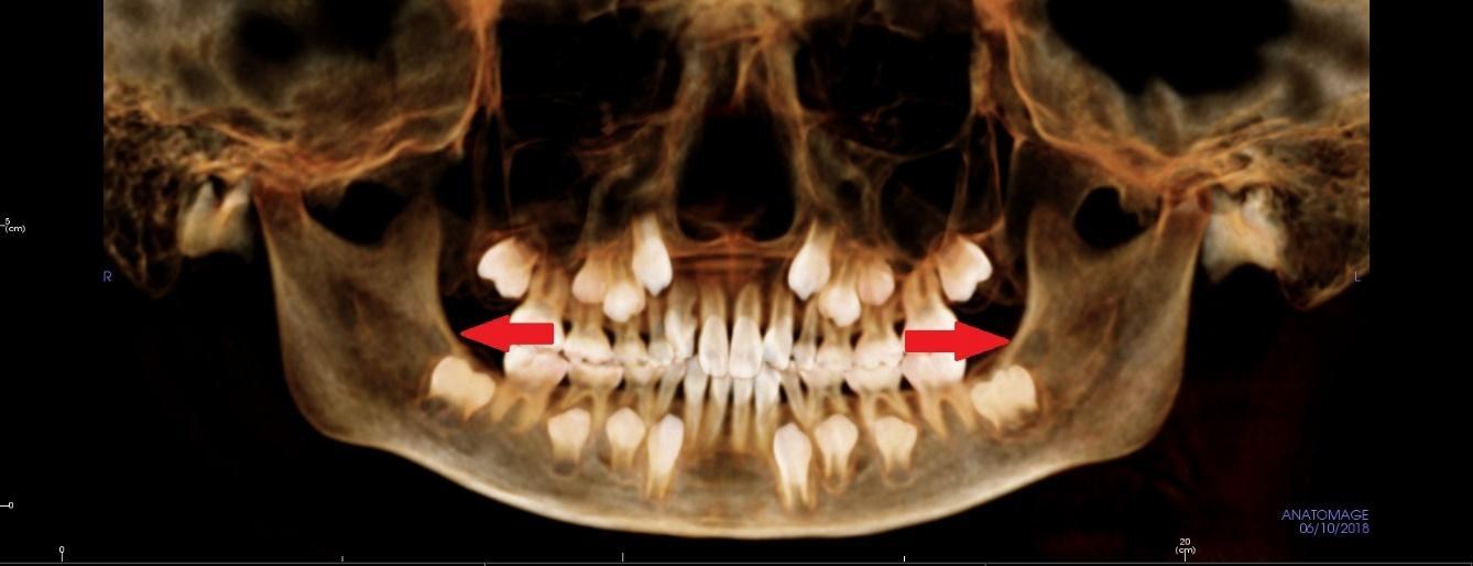 ほぼ痛くなかった 小学生の小さい親知らずの抜歯 親知らずの抜歯は小さい時が楽です 広島市西区のアルパーク歯科 矯正 栄養クリニック