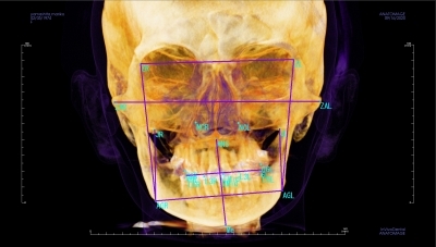 歯医者のマウスピースと顔面の変形のセファロ画像,広島市,西区,草津新町,アルパーク歯科・矯正・栄養クリニック