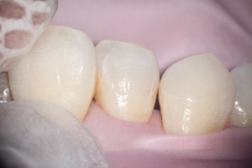 歯と歯の間に虫歯があります
