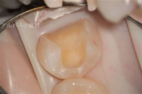 歯垢の除去