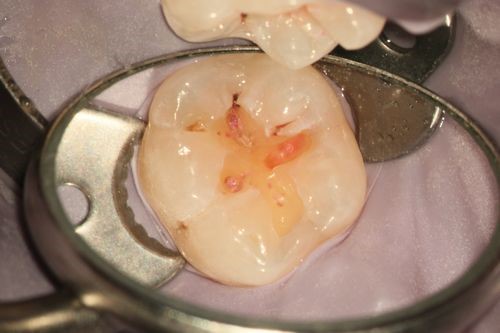 エナメル質の下に虫歯が入り込んでいる