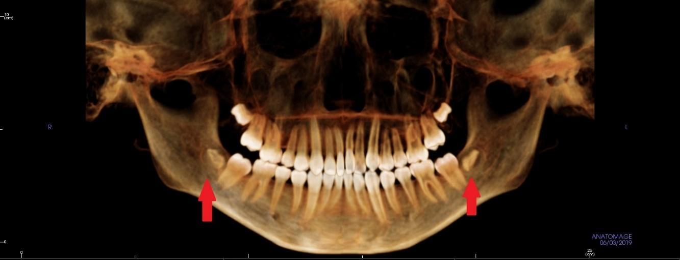 ほぼ痛くなかった 小学生の小さい親知らずの抜歯 親知らずの抜歯は小さい時が楽です 広島市西区のアルパーク歯科 矯正 栄養クリニック