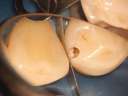 歯がしみる原因　気がつかない虫歯の画像,広島市,西区,草津新町,アルパーク歯科・矯正・栄養クリニック
