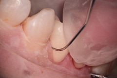 歯と歯の間もマイクロで見てセメントを除去します